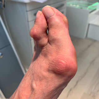 Hallux Valgus