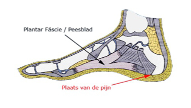 Hielpijn | Expertisecentrum Podotherapie