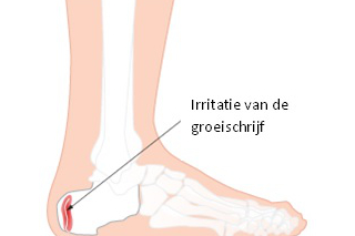 Morbus Sever (hielpijn bij kinderen)